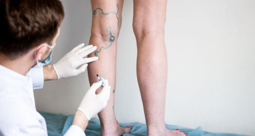 Varicose Veins Treatment in Delhi