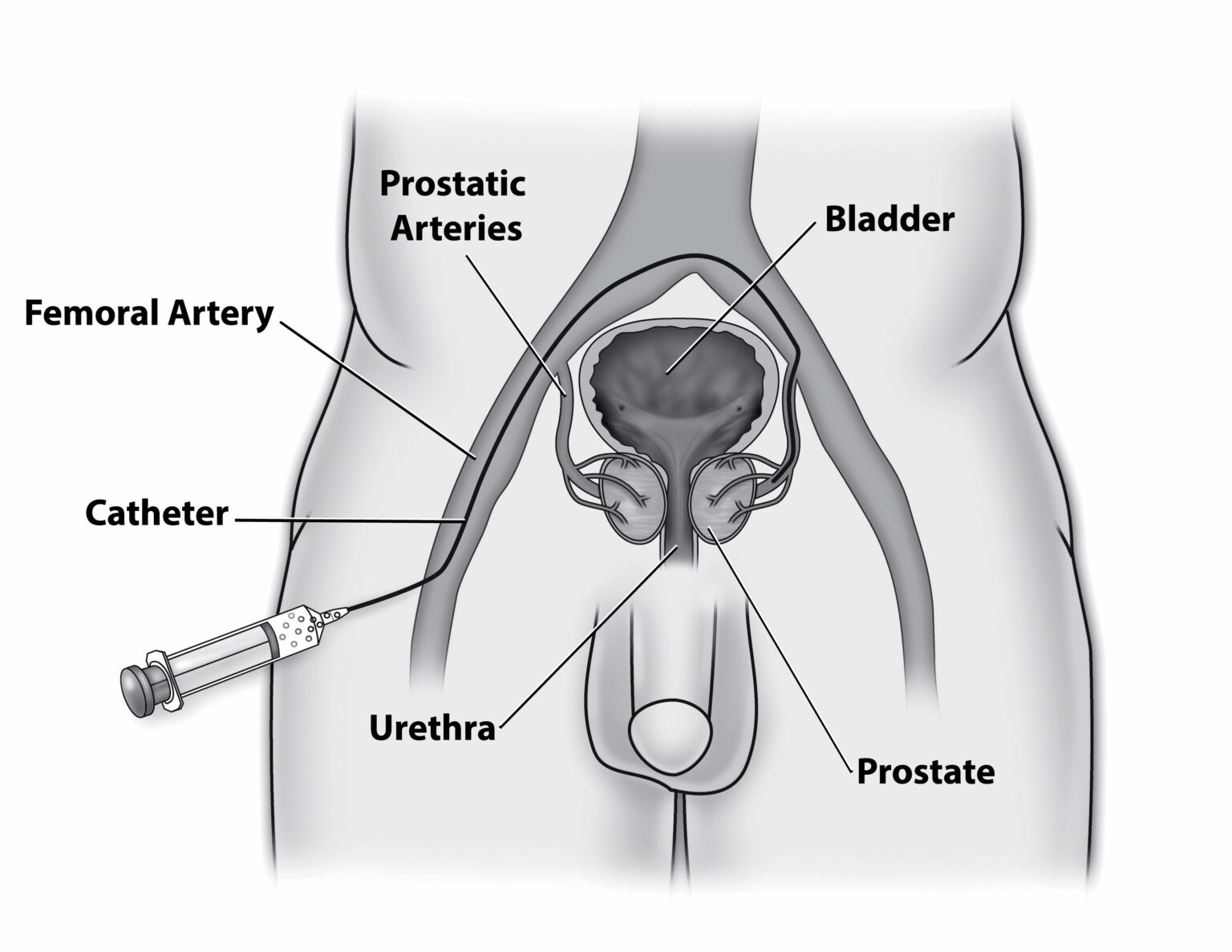 Prostatic Artery Embolization (PAE) Treatment In Delhi