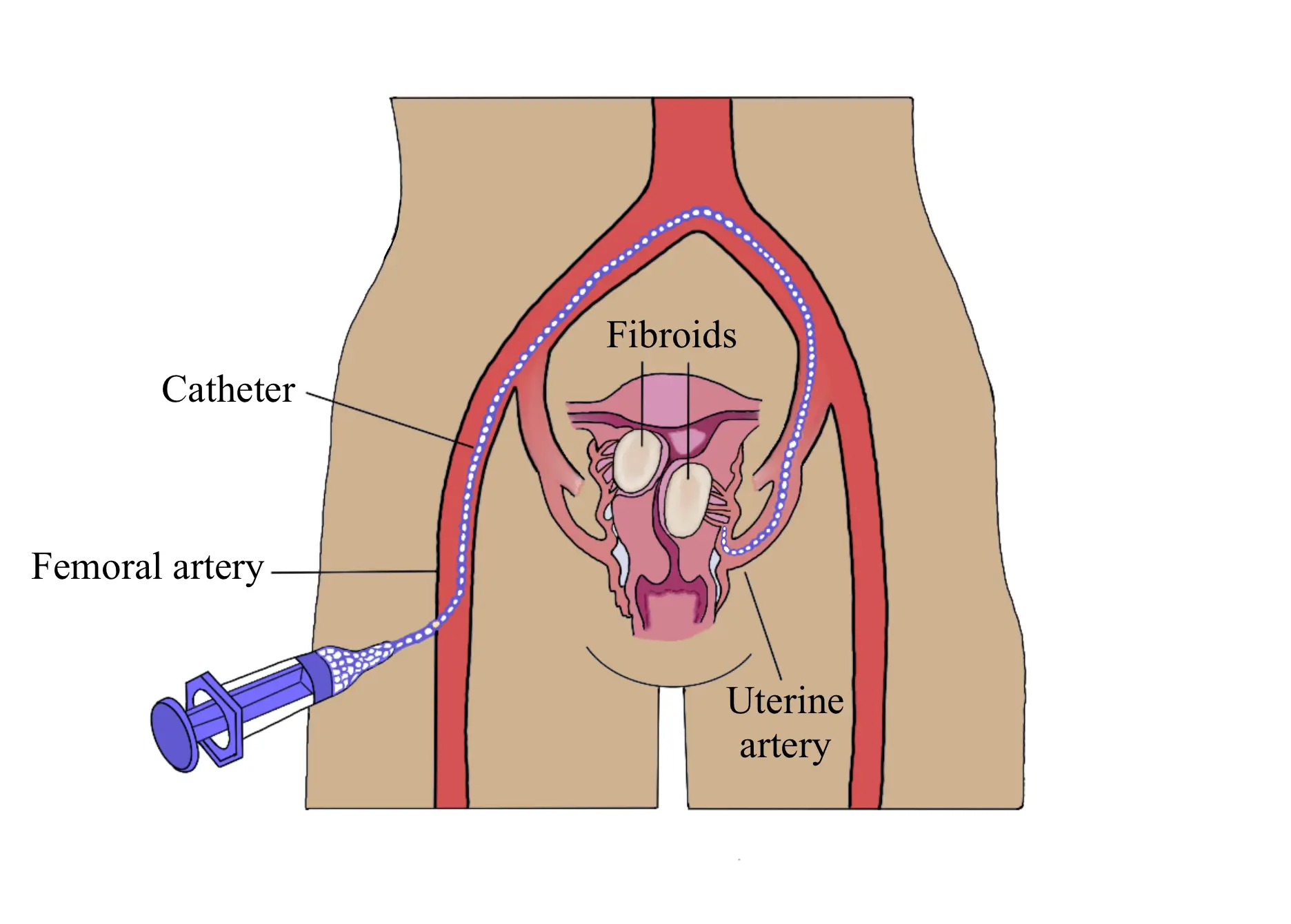 Uterine Artery Embolisation (UAE) & Fibroid Ablation Treatment in Delhi