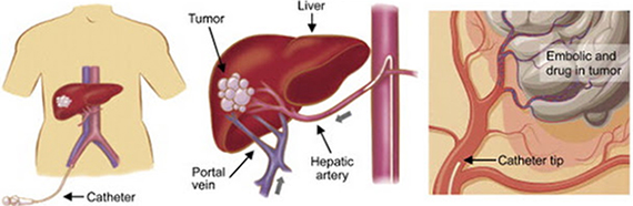 Liver Tumor Treatment In Delhi