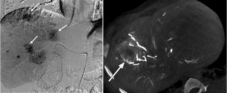 Liver Tumor Treatment In Delhi