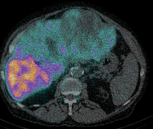 Liver Tumor Treatment In Delhi