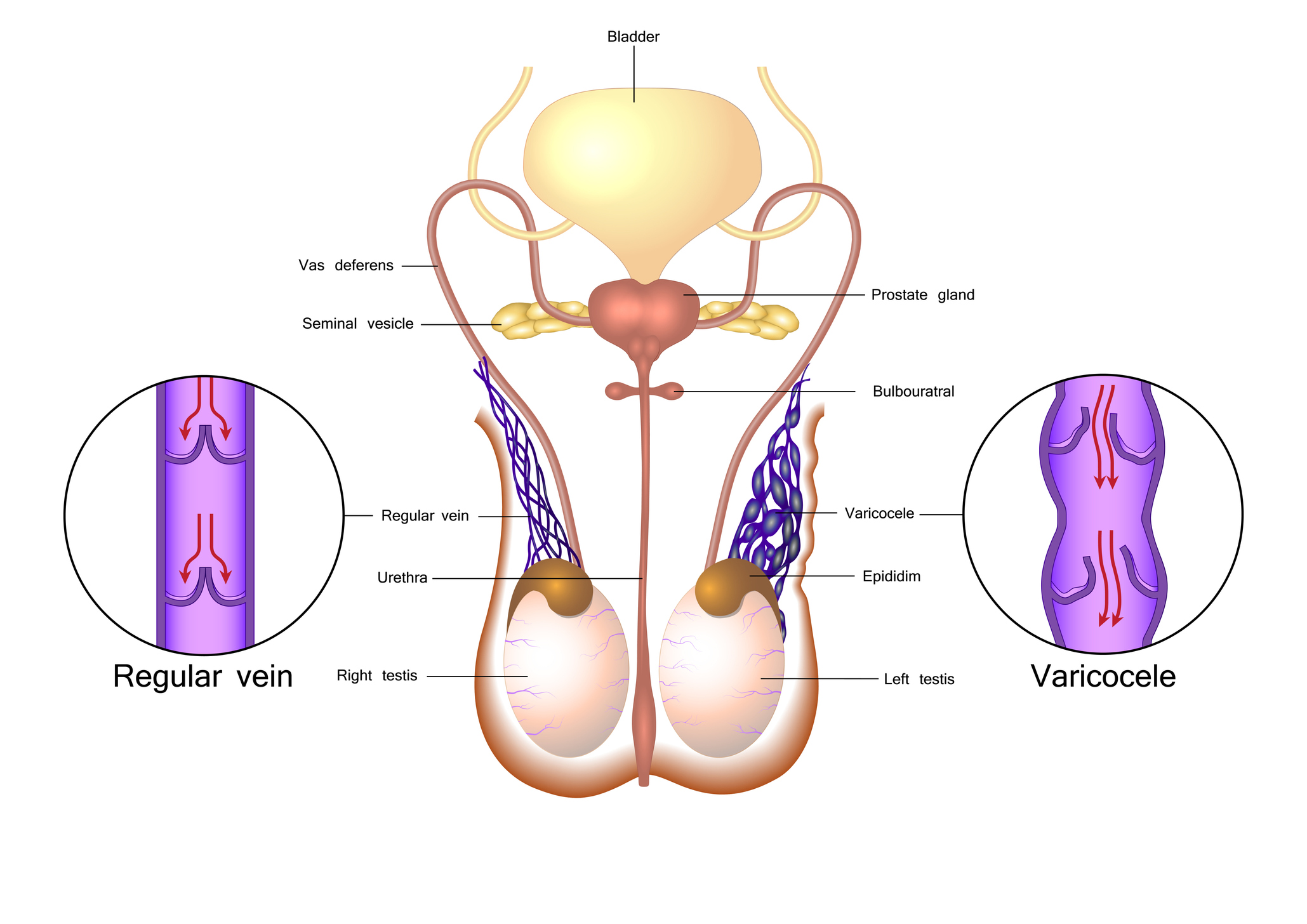 Varicocele Embolization Treatment in Delhi, India