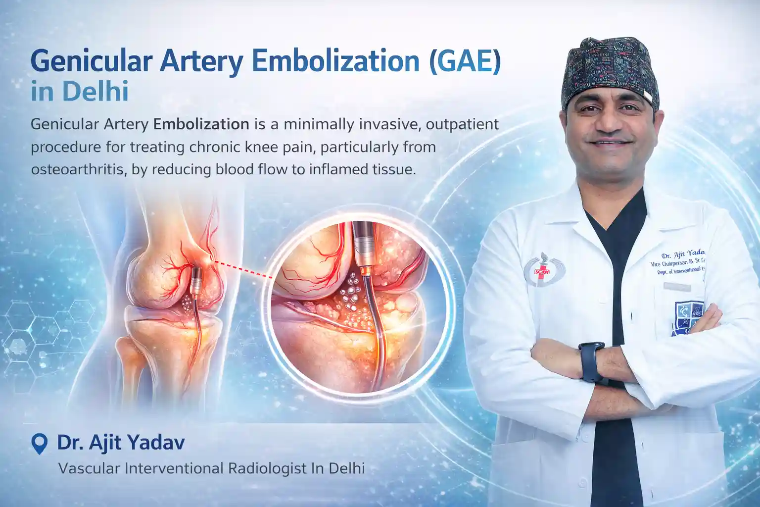 Genicular Artery Embolization in Delhi