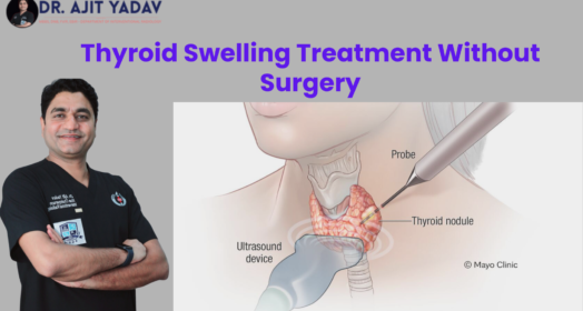 Thyroid Swelling Treatment Without Surgery