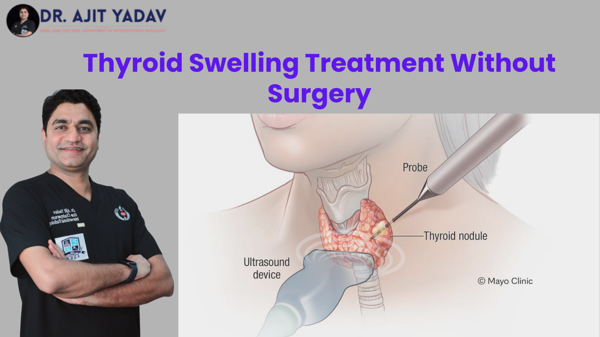 Thyroid Swelling Treatment Without Surgery