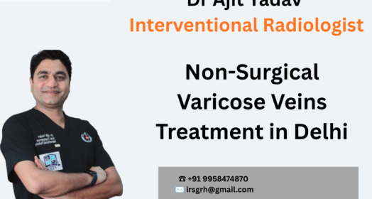 Non-Surgical Varicose Veins Treatment in Delhi