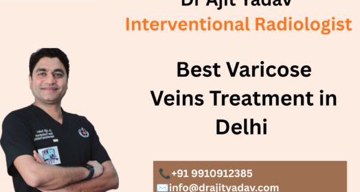 Best Varicose Veins Treatment in Delhi