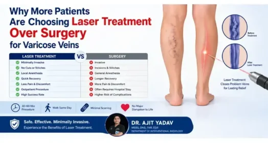 Why More Patients Are Choosing Laser Treatment Over Surgery for Varicose Veins