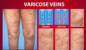 Non-Surgical Varicose Veins Treatment in Delhi 3 images 3 1
