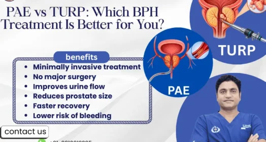 PAE vs TURP: Which BPH Treatment Is Right for You?