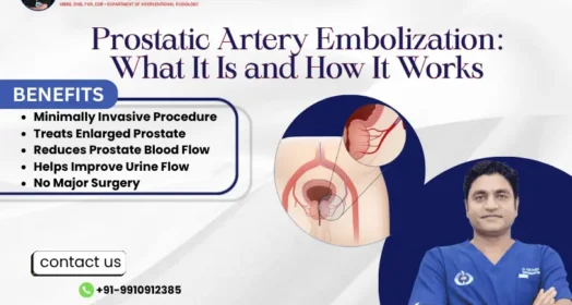 Prostatic Artery Embolization: How It Works