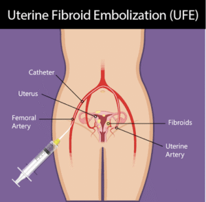 Uterine Fibroid Embolization Procedure