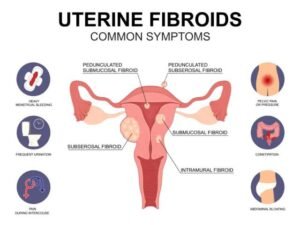uterine fibroids