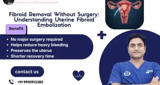 Fibroid Removal Without Surgery: Understanding Uterine Fibroid Embolization