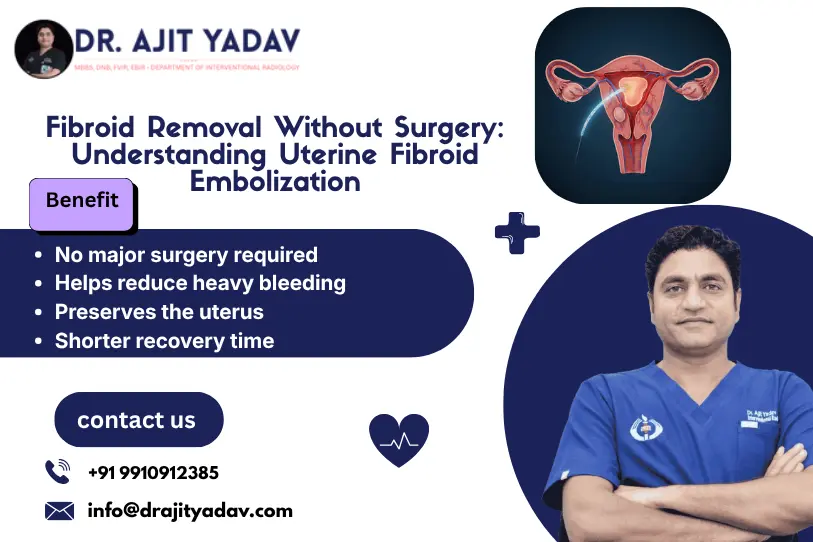 Fibroid Removal Without Surgery: Understanding Uterine Fibroid Embolization
